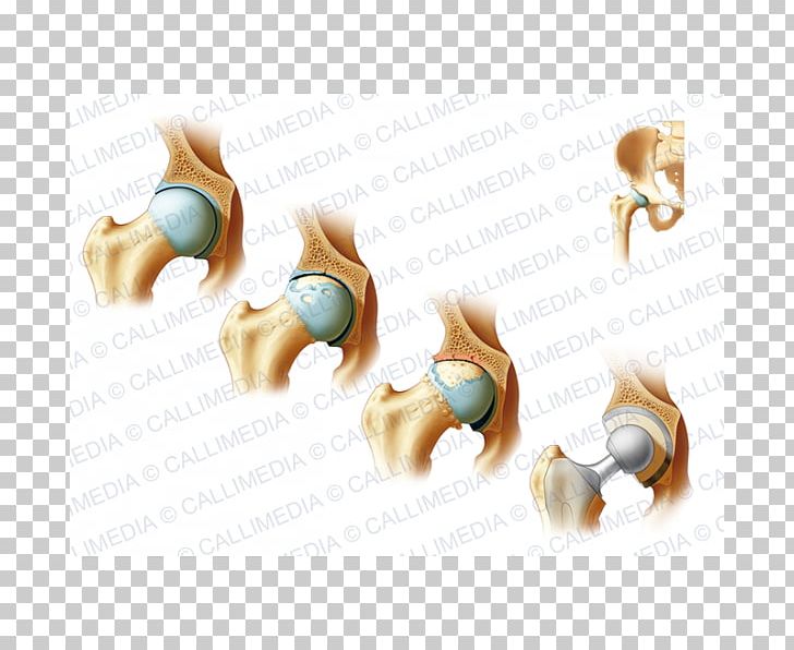 Bone Fracture Cat Arthritis Clavicle Fracture Rheumatology PNG, Clipart, Anatomy, Animals, Arthritis, Body Jewellery, Body Jewelry Free PNG Download