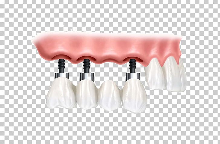 Dental Implant Dentistry Bridge PNG, Clipart, Allon4, Bowling Pin, Crown, Dental Surgery, Dentist Free PNG Download