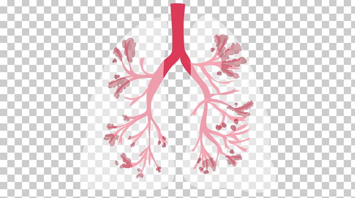 Chronic Obstructive Pulmonary Disease Bronchitis Health Obstructive Lung Disease Irritable Bowel Syndrome PNG, Clipart, Acute Disease, Branch, Bronchitis, Chronic Condition, Disease Free PNG Download