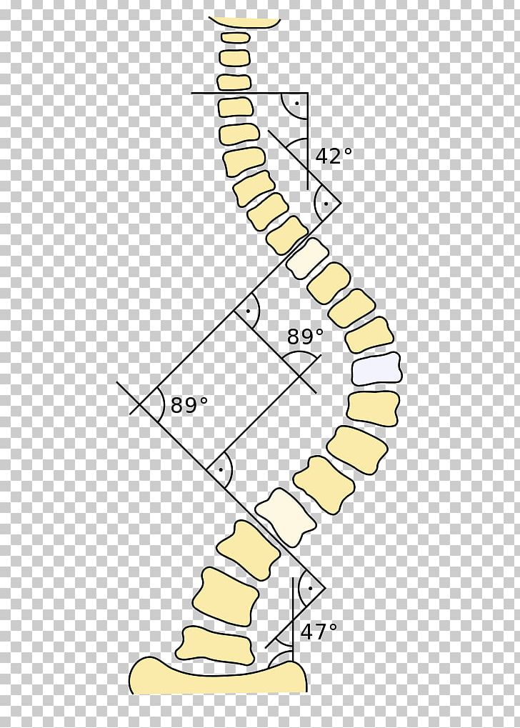Cobb Angle Three-Dimensional Treatment For Scoliosis: A Physiotherapeutic Method For Deformities Of The Spine Kyphosis Disease PNG, Clipart, Angle, Area, Cobb Angle, Degree, Diagram Free PNG Download