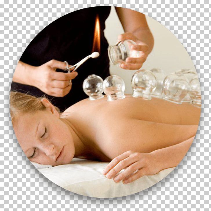 Cupping Therapy Massage Traditional Chinese Medicine Acupuncture PNG, Clipart, Ache, Acupressure, Acupuncture, Alternative Health Services, Beauty Salon Free PNG Download