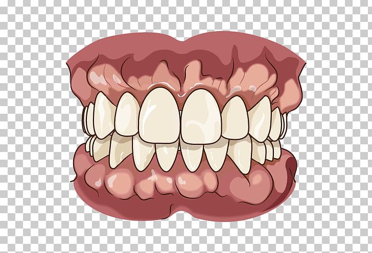 Tooth Jaw Dentures Chewing Bruxism PNG, Clipart, Alveolar Ridge, Bruxism, Cheek, Chewing, Dental Alveolus Free PNG Download