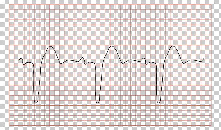 Left Bundle Branch Block Right Bundle Branch Block Bundle Branches Electrocardiography PNG, Clipart, Angle, Area, Atrioventricular Block, Atrioventricular Node, Diagram Free PNG Download