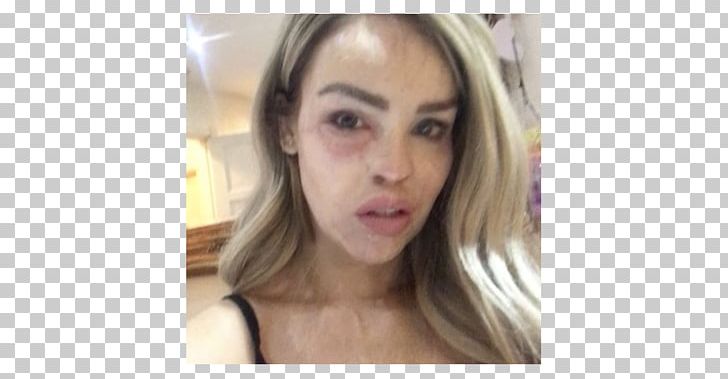 Katie Piper Acid Throwing Model Disfigurement PNG, Clipart, Acid, Acid Throwing, Blond, Brown Hair, Celebrities Free PNG Download