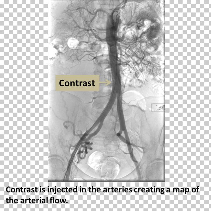 Computed Tomography Angiography Femoral Artery Coronary Catheterization Medical Procedure PNG, Clipart, Angiography, Angioplasty, Artery, Black And White, Catheter Free PNG Download