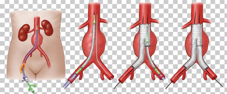 Abdominal Aortic Aneurysm Endovascular Aneurysm Repair Vascular Surgery PNG, Clipart, Abdomen, Abdominal Aortic Aneurysm, Aneurysm, Aorta, Aortic Aneurysm Free PNG Download
