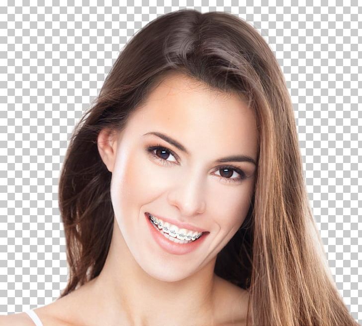 Orthodontics Palms Dental Centre Cosmetic Dentistry PNG, Clipart, Brown Hair, Cheek, Chin, Clear Aligners, Cosmetic Dentistry Free PNG Download