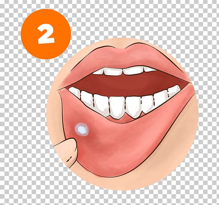 Tooth Mouth Ulcer Miconazole Oral Administration Tongue PNG, Clipart, Aphthous Stomatitis, Candidiasis, Cheek, Chin, Face Free PNG Download