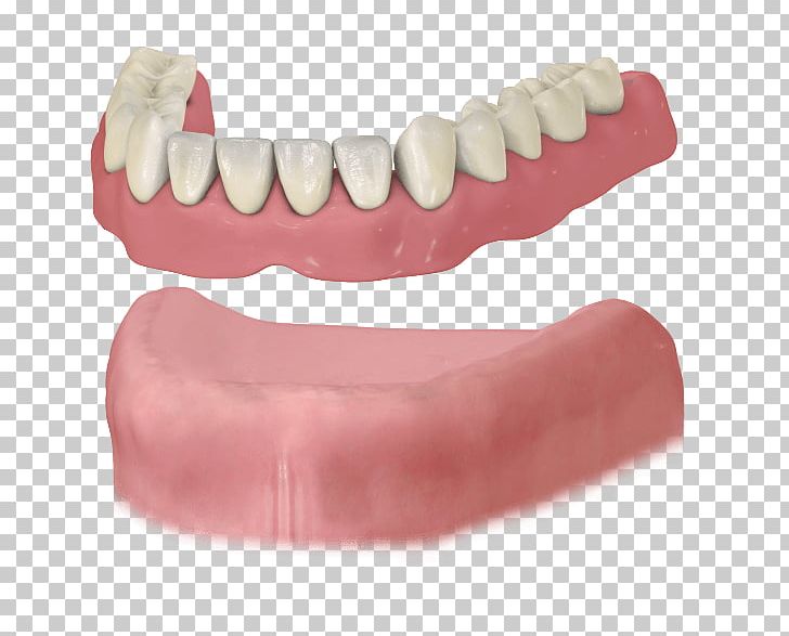 Dental Implant Dentures Removable Partial Denture Dentistry PNG, Clipart, Bridge, Cosmetic Dentistry, Crown, Dental, Dental Implant Free PNG Download