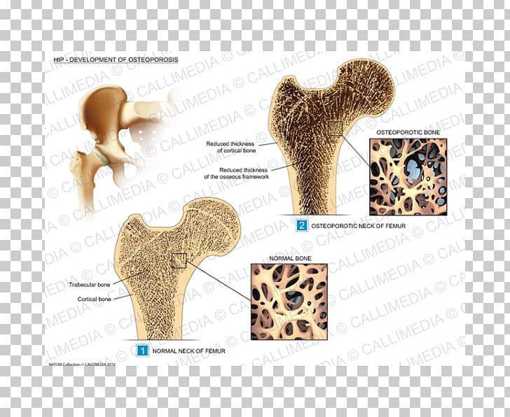 Hip Osteoporosis Rheumatology Osteoarthritis Illustration Anatomique PNG, Clipart, Acetabulum, Anatomy, Banco De Imagens, Bone Fracture, Ear Free PNG Download