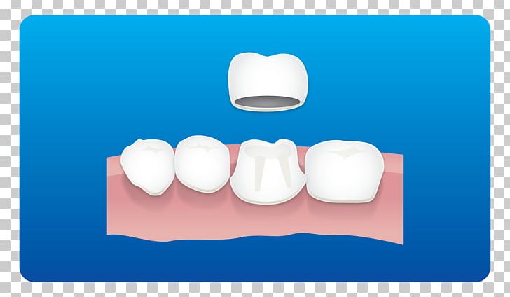 Tooth Dental Implant Root Canal Dentist Dental Restoration PNG, Clipart, Card, Computer Wallpaper, Dental Braces, Dental Care, Dental Clinic Free PNG Download