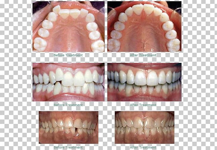 Dentistry Human Tooth Dental Braces Clear Aligners PNG, Clipart, Bridge, Clear Aligners, Cosmetic Dentistry, Crown, Dental Braces Free PNG Download