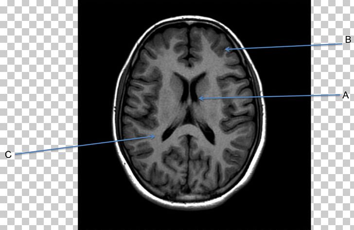 Magnetic Resonance Imaging Of The Brain Computed Tomography Magnetic Resonance Imaging Of The Brain Neuroimaging PNG, Clipart, Angle, Brain, Clinical Neuroscience, Histogram Equalization, Lesion Free PNG Download