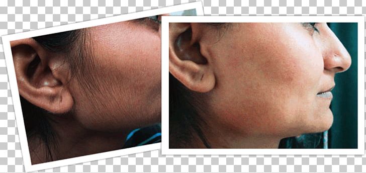 Hair Removal Facial Hair Woman Human Hair Growth PNG, Clipart, Body Hair, Cheek, Chin, Ear, Eyebrow Free PNG Download