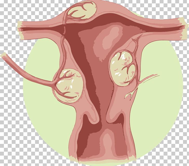Uterine Fibroid Uterine Artery Embolization Uterus Benign Tumor PNG, Clipart, Ear, Embolization, Fibroma, Gynaecology, Head Free PNG Download