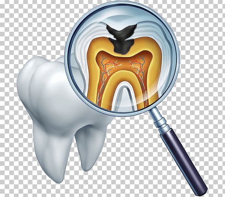 Tooth Decay Dentistry Therapy PNG, Clipart, Canal, Dental Restoration, Dentist, Dentistry, Endodontics Free PNG Download