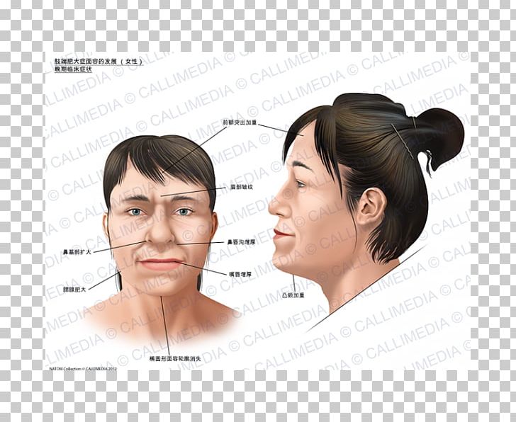 Acromegaly Face Symptom Skull Bossing Gigantism PNG, Clipart, Acromegaly, Cheek, Chin, Clinic, Ear Free PNG Download