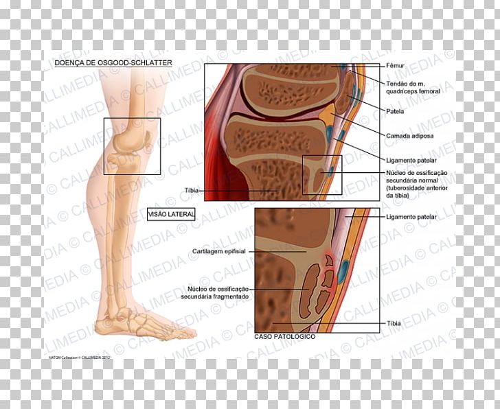 Osgood–Schlatter Disease Tuberosity Of The Tibia Growing Pains Therapy PNG, Clipart, Abdomen, Angle, Ankylosing Spondylitis, Arm, Calf Free PNG Download