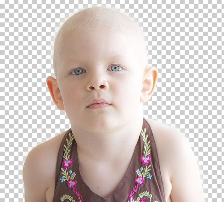 Burkitt's Lymphoma Cancer Therapy Child PNG, Clipart,  Free PNG Download