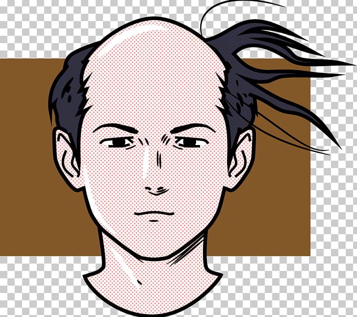 Pattern Hair Loss Management Of Hair Loss Hair Whorl Capelli PNG, Clipart, Capelli, Cheek, Chin, Ear, Emotion Free PNG Download