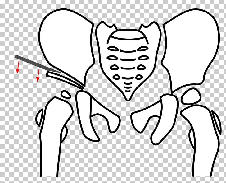 Osteotomy Pelvis Triple-Osteotomie Hip Dysplasia Acetabulum PNG, Clipart, Angle, Area, Artwork, Black, Black And White Free PNG Download