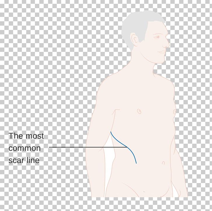 Thumb Drawing Surgery Scar PNG, Clipart, Abdomen, Angle, Arm, Back, Cancer Free PNG Download