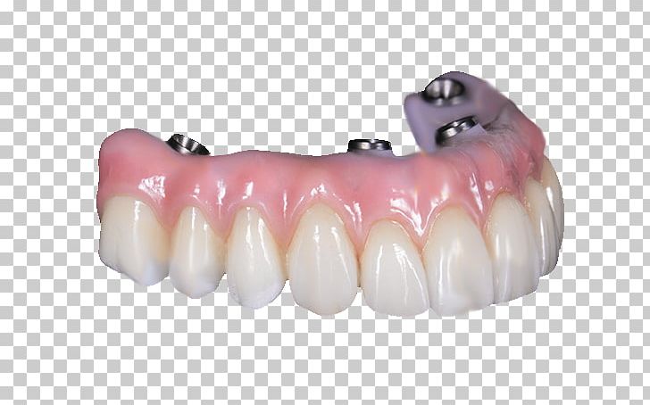 Tooth All-on-4 Dentures Bridge Dental Implant PNG, Clipart, Allon4, All On 4, Bridge, Ceramic, Crown Free PNG Download