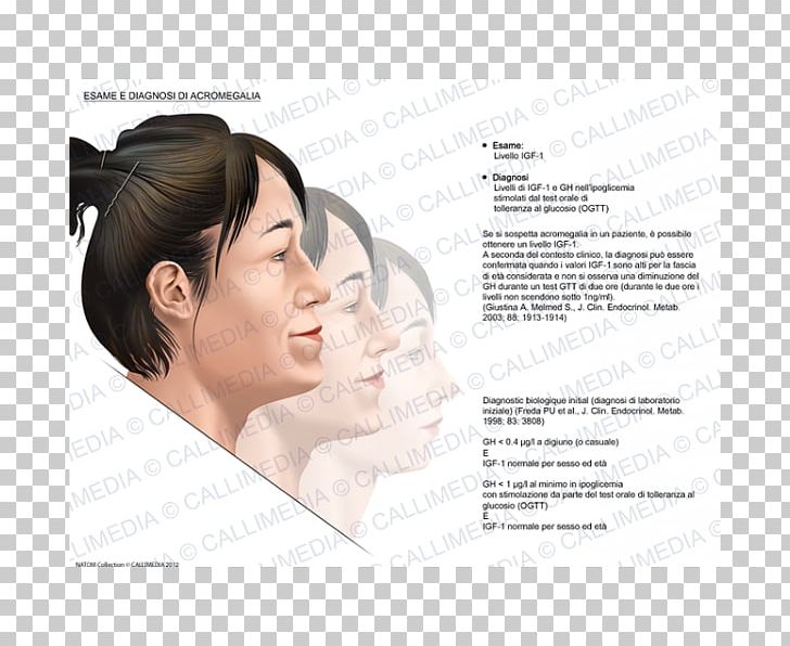 Acromegaly Diagnose Medical Diagnosis Symptom PNG, Clipart, Beauty, Cheek, Chin, Diabetes Mellitus, Diagnose Free PNG Download