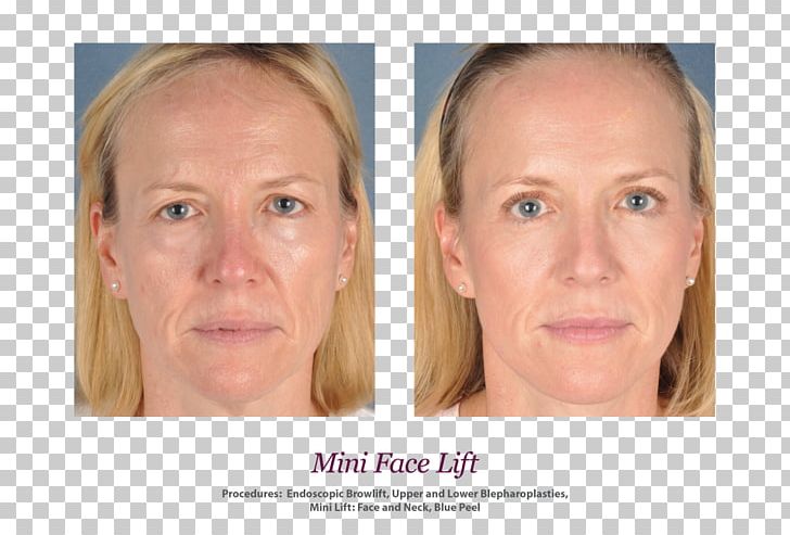 Skin Face Rhytidectomy Wrinkle Surgery PNG, Clipart, Cheek, Chin, Collagen, Dermatology, Ear Free PNG Download