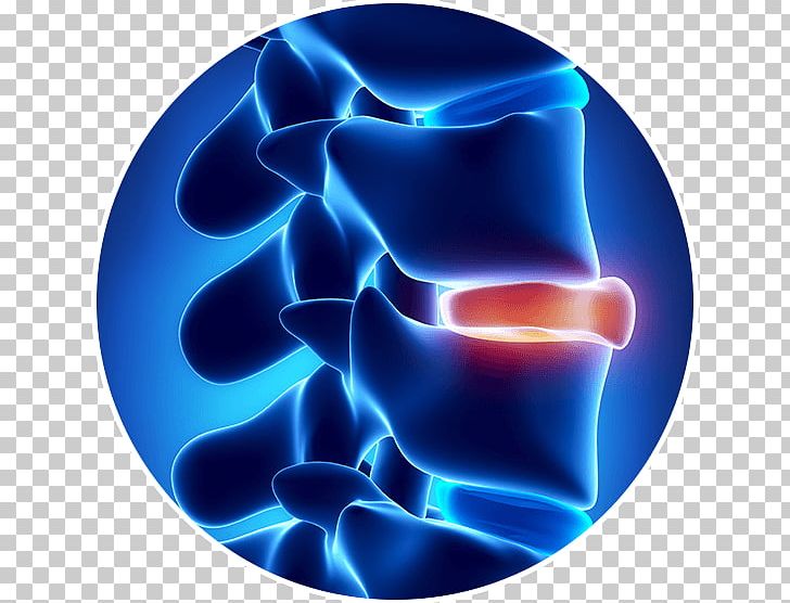 Spinal Disc Herniation Vertebral Column Intervertebral Disc Tratamento Back Pain PNG, Clipart, Back Pain, Computer Wallpaper, Disease, Electric Blue, Hernia Free PNG Download