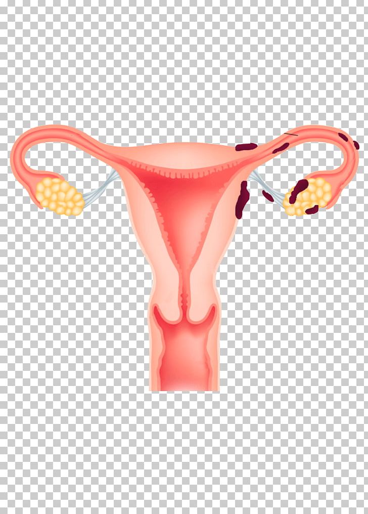 Endometrium Endometriosis Uterus Menstruation Ovary PNG, Clipart, Disease, Endometriosis, Endometrium, Hormone, Implant Free PNG Download