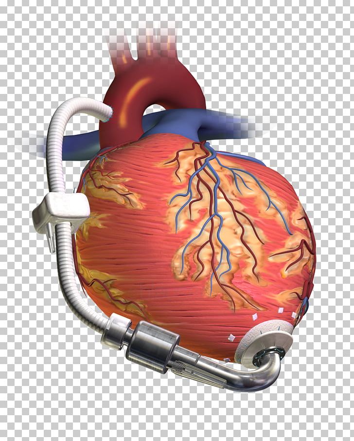 Ventricular Assist Device Heart Transplantation Artificial Heart Ventricle PNG, Clipart, Artificial Heart, Artificial Heart Valve, Cardiac Surgery, Cardiology, Heart Free PNG Download