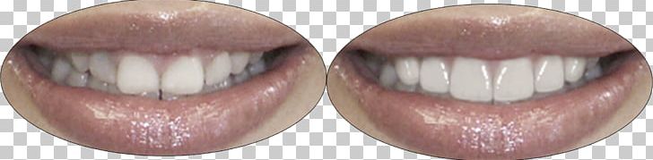 Crown Lengthening Veneer Dentistry Mouth PNG, Clipart, Cheek, Chin, Crown, Crown Lengthening, Dental Implant Free PNG Download