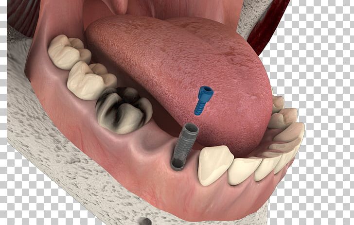 Dental Implant Dentistry Therapy Tooth PNG, Clipart, Bone, Dental Implant, Dentist, Dentistry, Dentures Free PNG Download