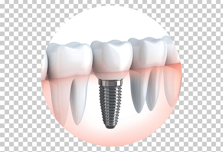 Dental Implant Cosmetic Dentistry Dental Surgery PNG, Clipart, Bone Grafting, Brush, Cosmetic Dentistry, Dental, Dental Implant Free PNG Download