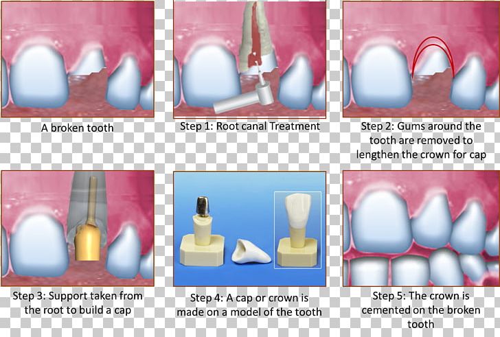 Crown Root Canal Cracked Tooth Syndrome Human Tooth PNG, Clipart, Abutment, Advertising, Brand, Canal, Crown Free PNG Download