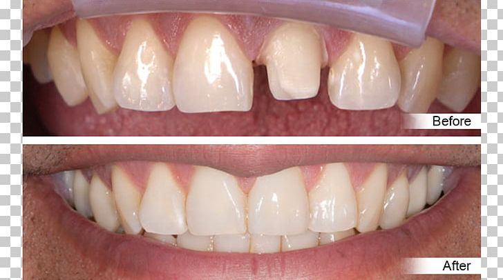 Crown Tooth Dentistry Dental Restoration PNG, Clipart, Amalgam, Anterior, Bridge, Cadcam Dentistry, Ceramic Free PNG Download