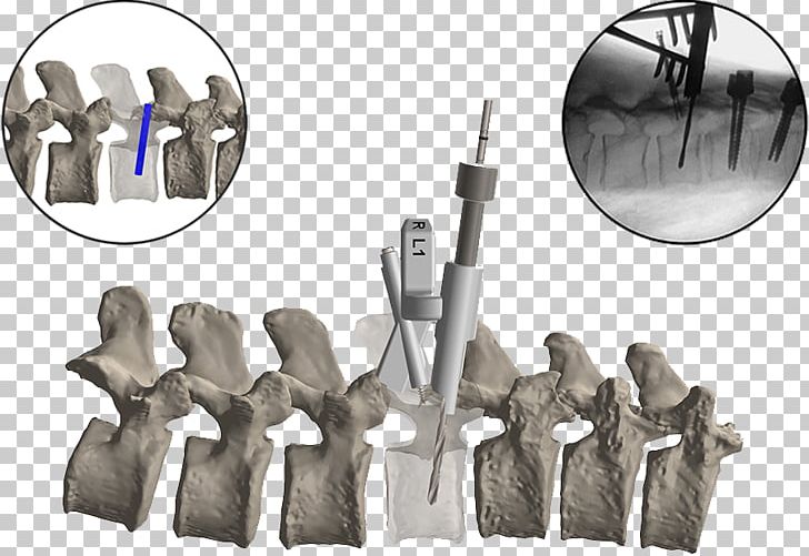 Vertebral Column Spinal Fusion Surgery Cervical Vertebrae Lumbar PNG, Clipart, 3 D Print, 3d Printing, Anatomy, Cervical Vertebrae, Firefly Free PNG Download
