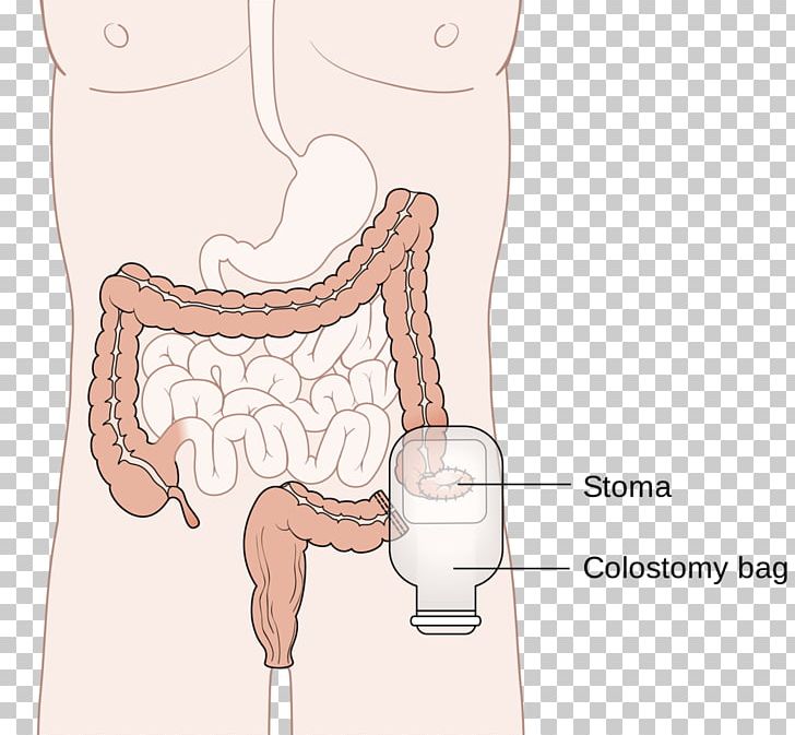 Colostomy Colectomy Surgery Ileostomy Stoma PNG, Clipart, Abdomen, Arm, Art, Cartoon, Colectomy Free PNG Download