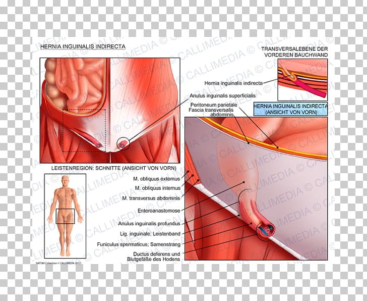 Inguinal Hernia Abdominal External Oblique Muscle Inguinal Canal Abdominal Internal Oblique Muscle PNG, Clipart, Abdomen, Abdominal External Oblique Muscle, Anatomy, Angle, Arm Free PNG Download