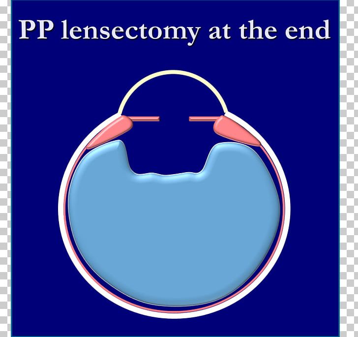 Aphakia Congenital Cataract Lens Diplopia PNG, Clipart, Angle, Anterior, Area, Autosome, Birth Free PNG Download