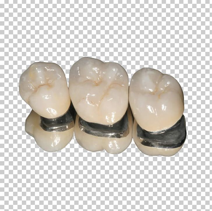 Crown Dentistry Bridge Ceramic PNG, Clipart, Alloy, Bridge, Ceramic, Cosmetic Dentistry, Crown Free PNG Download