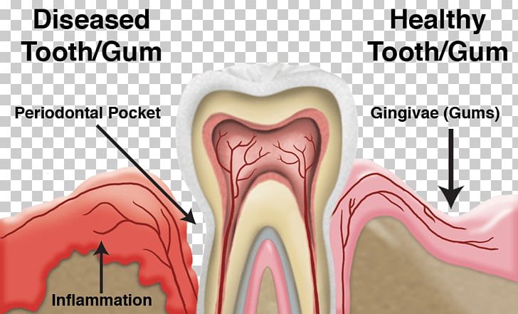 Tooth Periodontal Disease Dentistry Gums PNG, Clipart, Bleeding On Probing, Clinic, Dental Plaque, Dentist, Dentistry Free PNG Download