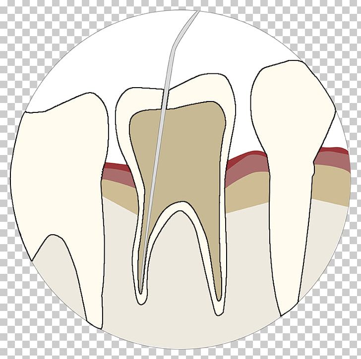 Tooth Velopex International Dentistry Air-Polishing Endodontics PNG, Clipart, Abrasion, Air, Airpolishing, Anesthetic, Dentistry Free PNG Download