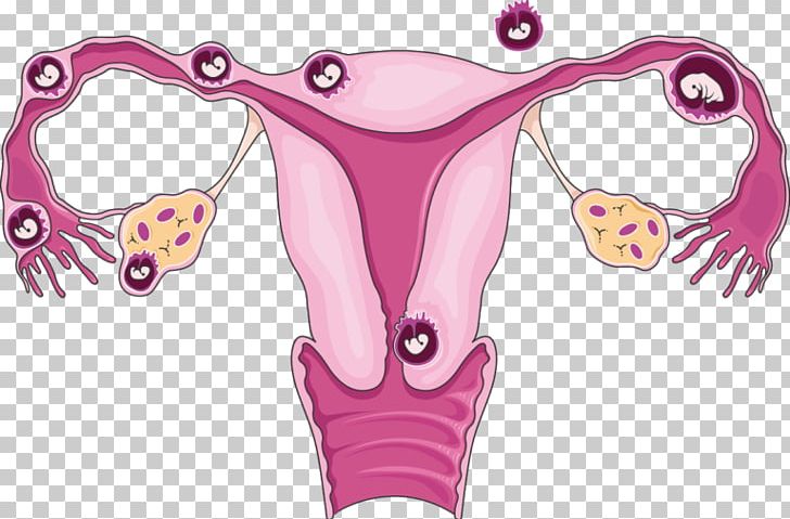 Ectopic Pregnancy Uterus Tubal Ligation Ultrasonography PNG, Clipart, Cervix, Ectopic Pregnancy, Embryo, Fallopian Tube, Fictional Character Free PNG Download