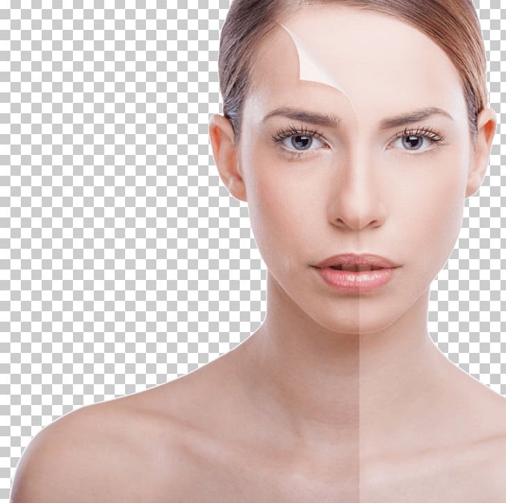 Chemical Peel Exfoliation Facial Photorejuvenation Beauty Parlour PNG, Clipart, Aesthetic Medicine, Alpha Hydroxy Acid, Beauty, Cheek, Chemical Peel Free PNG Download