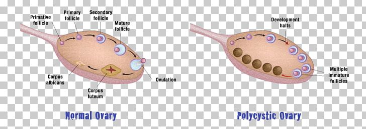 Polycystic Ovary Syndrome Ovarian Cyst Ovarian Disease PNG, Clipart, Cyst, Disease, Follicular Cyst Of Ovary, Health, Insulin Resistance Free PNG Download
