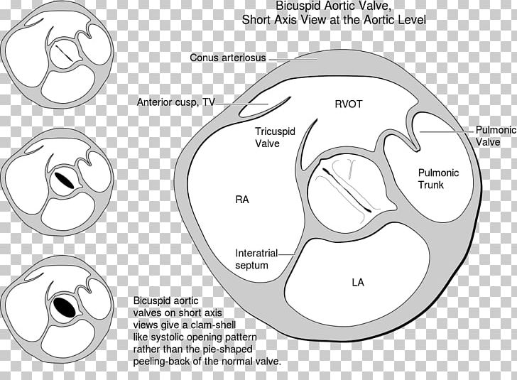 Bicuspid Aortic Valve Heart Valve Tricuspid Valve PNG, Clipart, Angle, Aorta, Aortic Insufficiency, Aortic Valve, Aortic Valve Replacement Free PNG Download