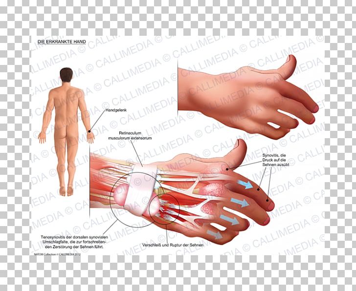 Thumb Product Design Hand Model Subcutaneous Nodules PNG, Clipart, Abdomen, Arm, Art, Finger, Hand Free PNG Download