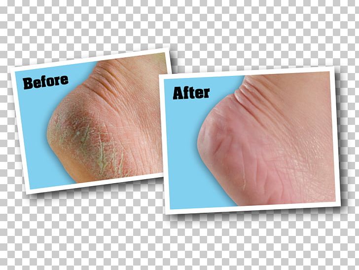 Lotion O'Keeffe's For Healthy Feet Foot Cream O'Keeffe's Working Hands Skin Care PNG, Clipart,  Free PNG Download